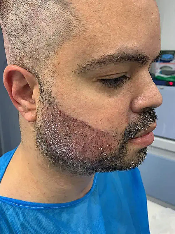 Beard Transplant Beard Transplant